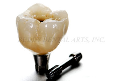 #30 Porcelain Fused to Metal -Screw Retained Implant-