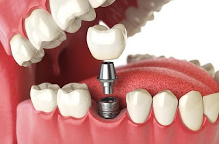 Cấy răng implant mất thời gian bao lâu-1