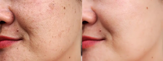 What causes dark spots and Patches on the face?