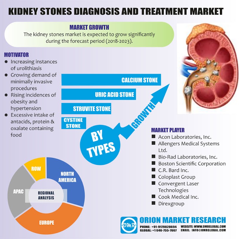  Evolution of Advanced Technologies for Diagnostic and Treatment of Kidney Stone