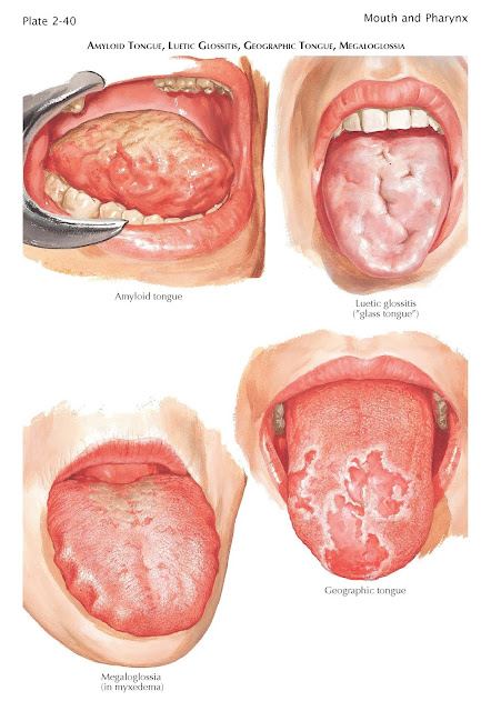 Manifestations of Disease of Tongue