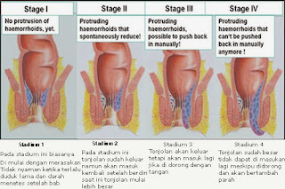 Harga Obat Wasir Ambeien De Nature Indonesia