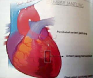 Gambar Cara Mengobati Jantung Koroner Tanpa Operasi