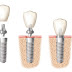 Trồng răng implant trong bao lâu thì hoàn thiện răng?
