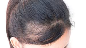 Alopecia