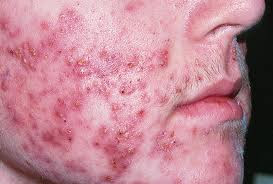 Cystic Acne