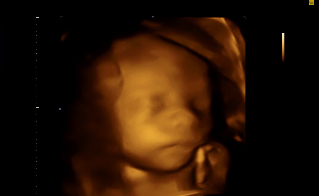 Notre Babinou Arrive Echographie 3d Gratuite A 25 Semaines De Grossesse