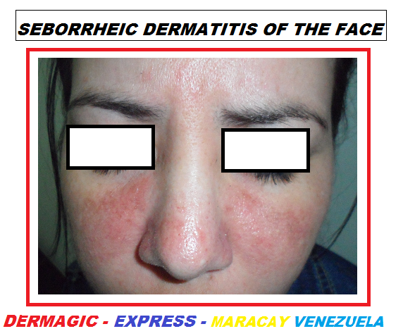 Seborrheic dermatitis of the face