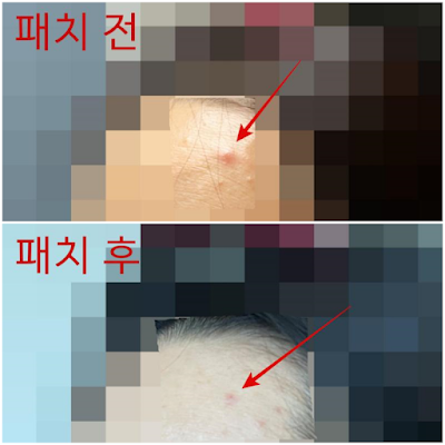 리바클린-슈퍼스타-여드름-패치-효과