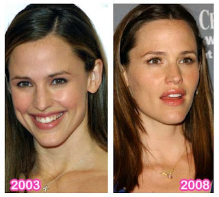 Jennifer Garner Plastic Surgery