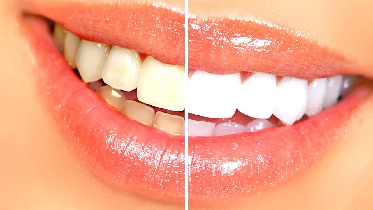 Cost For Teeth Whitening At Dentist Office