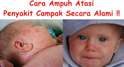 obat campak