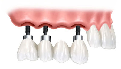 Thực hiện trồng răng implant khi bị mất nhiều răng