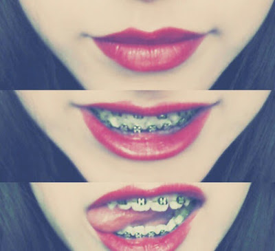 Fotos tumblr con brackets lindas