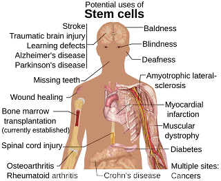 bone marrow transplant cost