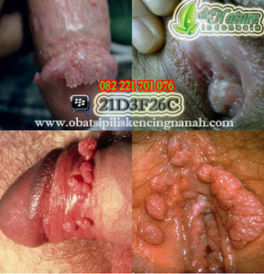 kutil anus pria kutil anus pria