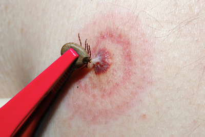 Home Remedies of Lyme Disease for Natural Cures