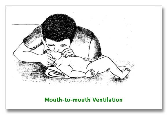 newborn resuscitation mouth to mought ventilation