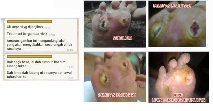 Ana Lyana's blog ©: Kaki Terselamat Dari Kena Potong 