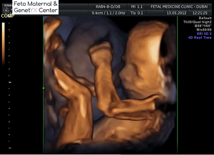 baby scan ultrasound