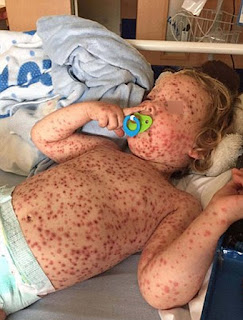  fever with severe rash all over the body disease pictures