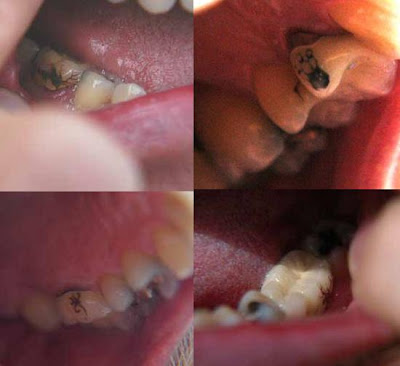 Unusual and Creative Tattoos on Teeth