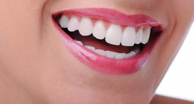 Tẩy trắng răng công nghệ Laser Whitening là gì?