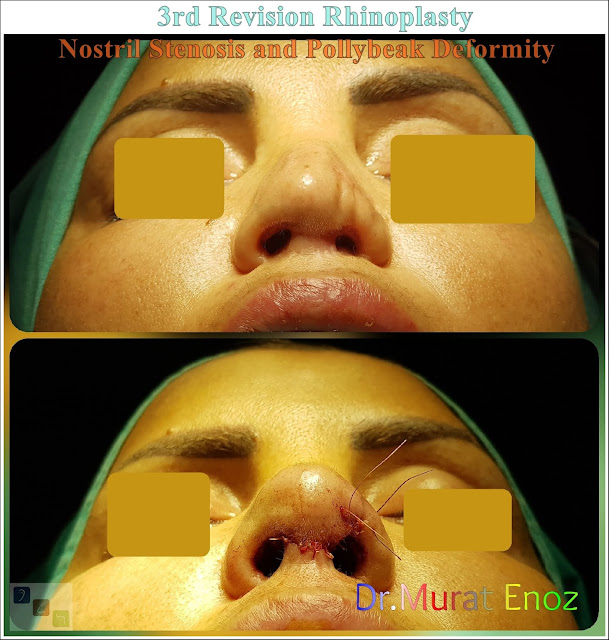 3rd Revision Rhinoplasty - Nostril Stenosis and Pollybeak Deformity - Complication Nose Surgery