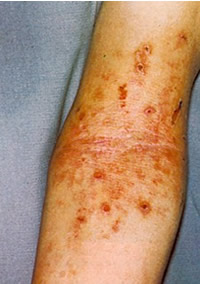 Come si manifesta un allergia sulla pelle