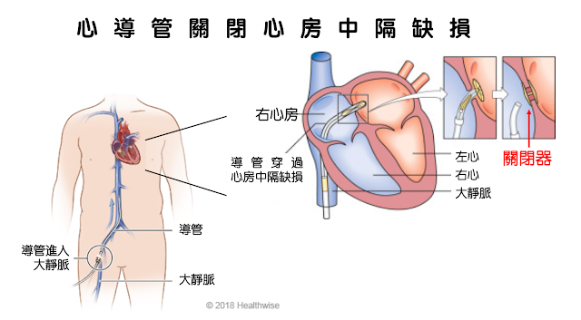 心導管關閉心房中膈缺損