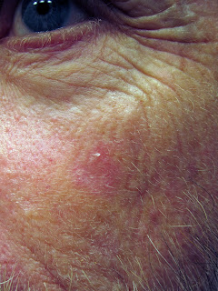 Actinic keratosis on cheek before Efudex