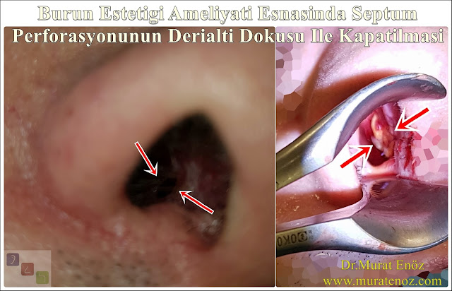 Deri altı dokusu ile septum perforasyonu tamiri - Deri altı dokusu ile septum perforasyonu ameliyatı - Septum perforasyonu tedavisi - Nazal septum perforasyonu operasyonu - Açık teknik septum perforasyonu ameliyatı - Açık teknik septum perforasyonu onarımı - Burun estetiği ile birlikte septum perforasyonu kapatılması - Burun septumunda delik kapatılması - Burun septum perforasyonu ameliyatı - Septum perforation closure in Istanbul - Septum perforation closure with under skin tissue - Closure of nasal septal perforations using under skin tissue - Combining rhinoplasty with septal perforation repair