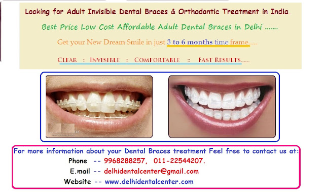 Dental Braces clinic Delhi, Dental Braces Delhi, orthodontist Delhi, Dental Braces in Delhi, Braces Dentist in Delhi, Braces Delhi, Braces Clinic in Delhi, Dental Braces Treatment in Delhi.