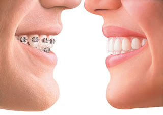 lingual braces cost in balwyn Victoria