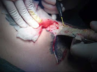 Excision means to remove by cutting. Tattooed part is cut off and ...
