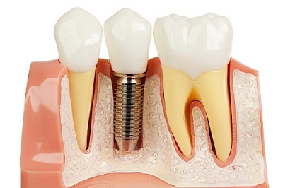 Công nghệ làm răng implant