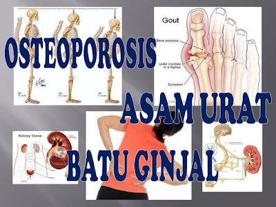 milagros untuk osteoporosis