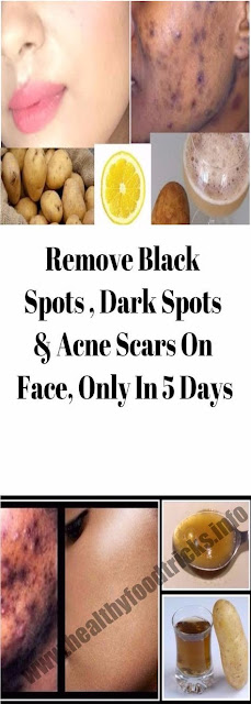 REMOVE BLACK SPOTS , DARK SPOTS & ACNE SCARS ON FACE, ONLY IN 5 DAYS