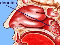 Resep Jus : Penyakit Adenoids