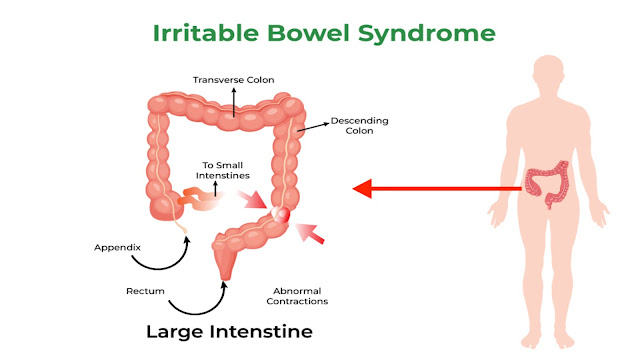 https://www.healthandfitnessexpert.in/2024/04/irritable-bowel-syndrome.html