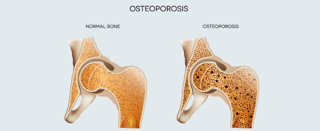 Bone health