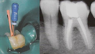 Endodontics