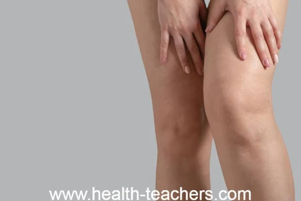 What are Arthritis and what treatment? - Health-Teachers
