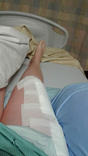 My operated leg, stretched out in a hospital bed,  covered in white bandages