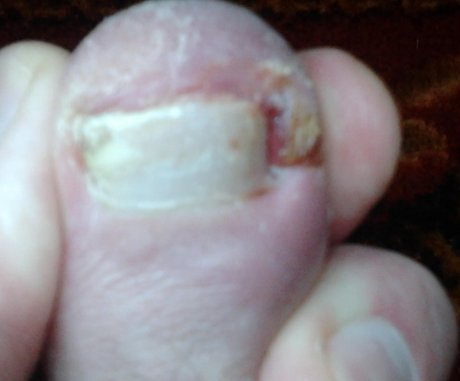 Вросший ноготь на ноге; после прогулки; обрезка ногтя; 14-й день применения медицинского спрея «Ламикон» / image5 / 2018.06.09 / 14:04
