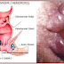 Bahaya dan penyebab penyakit wasir yang sangat mengerikan