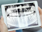 Piezas dentales infectadas con tratamiento de endodoncia