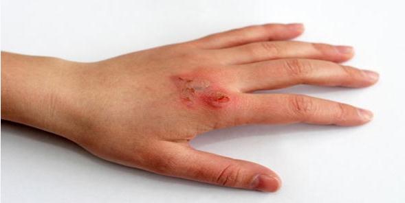 File:Apply Minor Skin Burns Common Remedies.svg