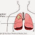 Apa Itu Kanker Paru Paru