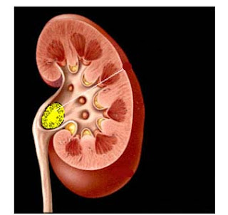 Kidney stones: can they be treated?